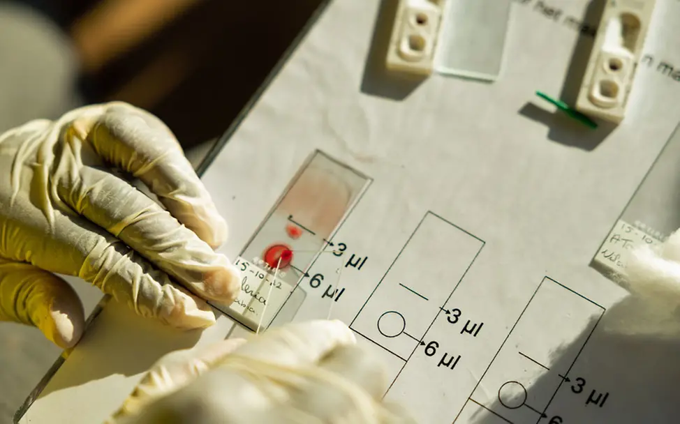 Malaria: Eine frühe Diagnostik verringert das Risiko für einen schweren Krankheitsverlauf. | © UNICEF/Slingshot Ein Gesundheitshelfer beim Durchführen von Malaria-Tests.