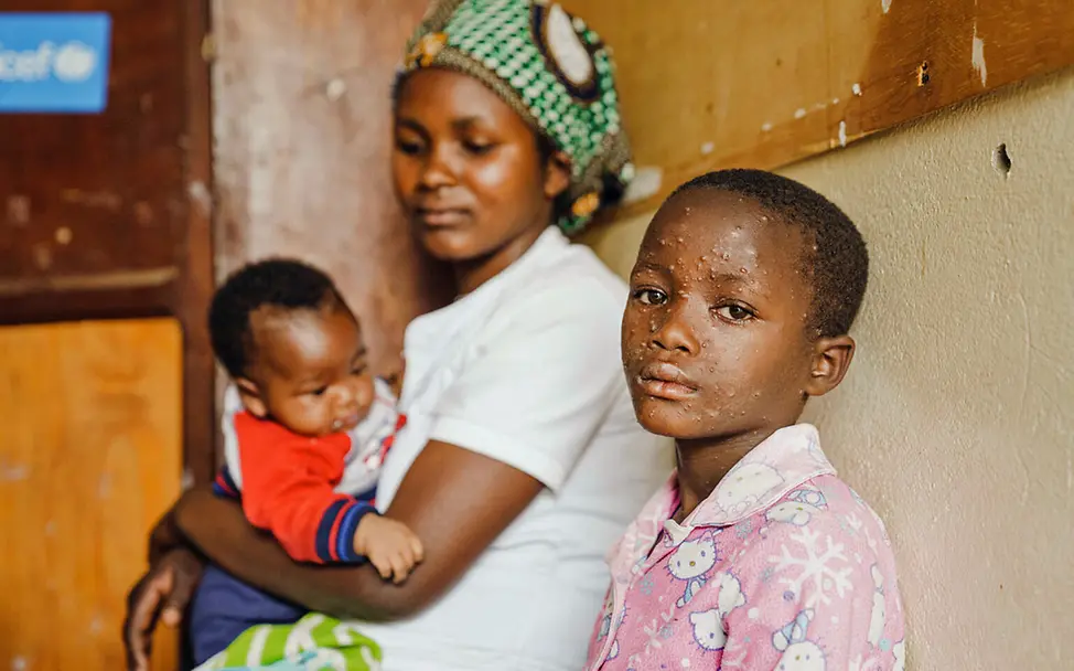 Ein an Mpox erkranktes Kind wartet auf ihre Behandlung | © UNICEF/Benekire Demokratische Republik Kongo Nothilfe: Ein an Mpox erkranktes Mädchen wartet in einem Gesundheitszentrum auf ihre Behandlung