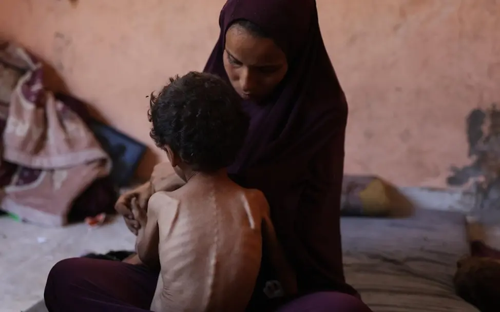 Der zweijährige Yazan ist schwer mangelernährt. | © UNICEF/El Baba Der zweijährige Yazan ist schwer mangelernährt.