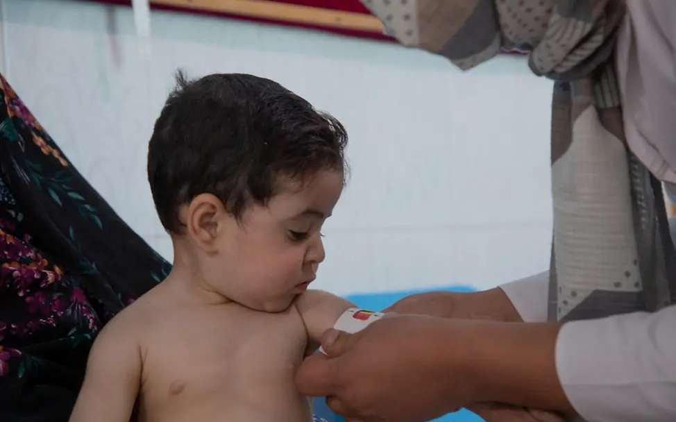 UNICEF-Gesundheitsteams untersuchen Kinder auf Mangelernährung. | © UNICEF/Azizi Afghanistan: Ein Mädchen wird wegen ihrer Mangelernährung untersucht.